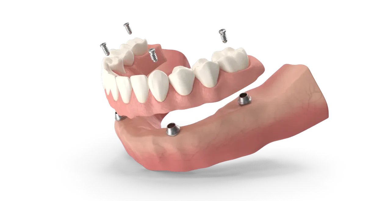 All on 4 Dental Implants in Albania
