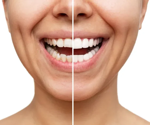 Before and after dental implants albania