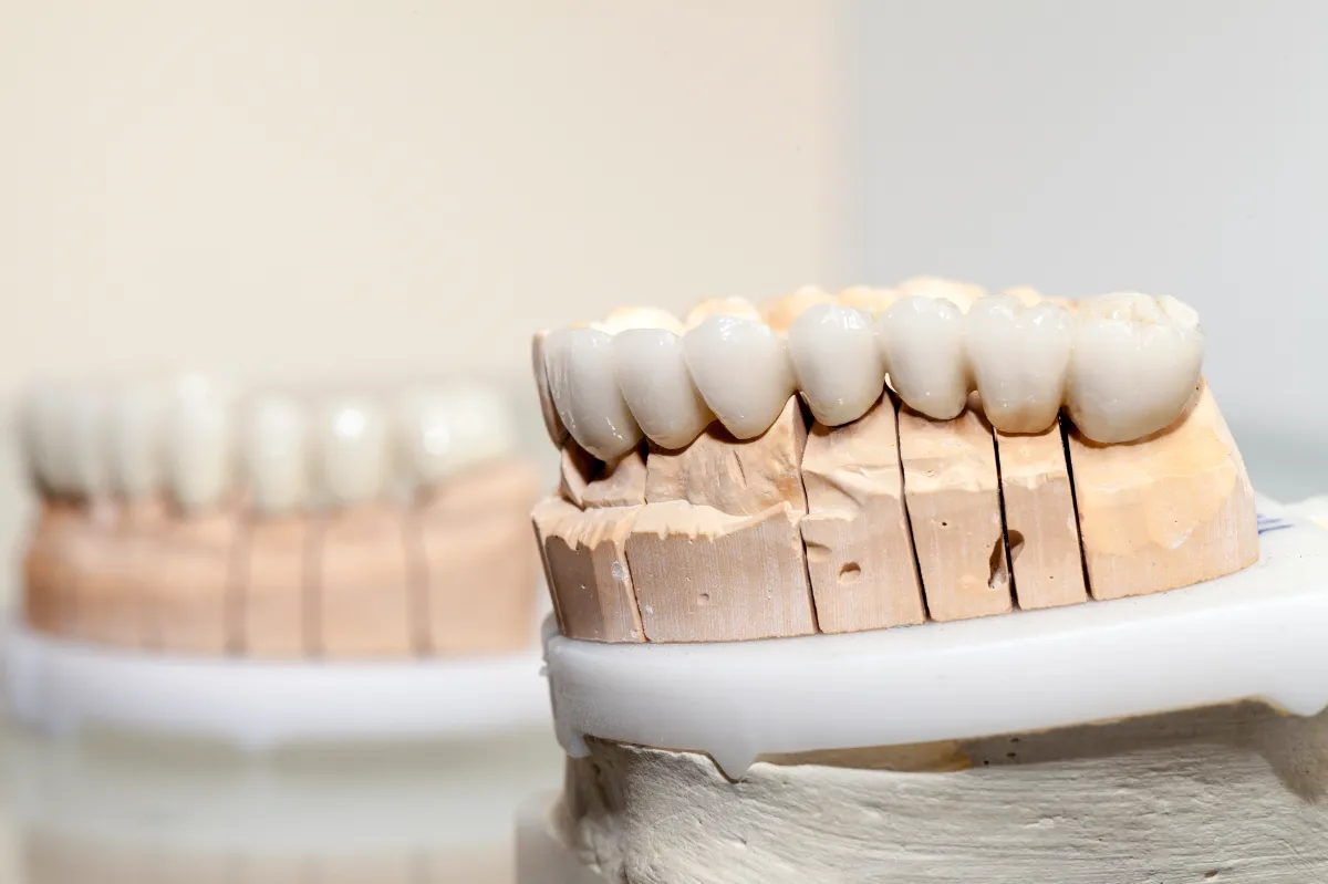 Dental Crowns in Albania