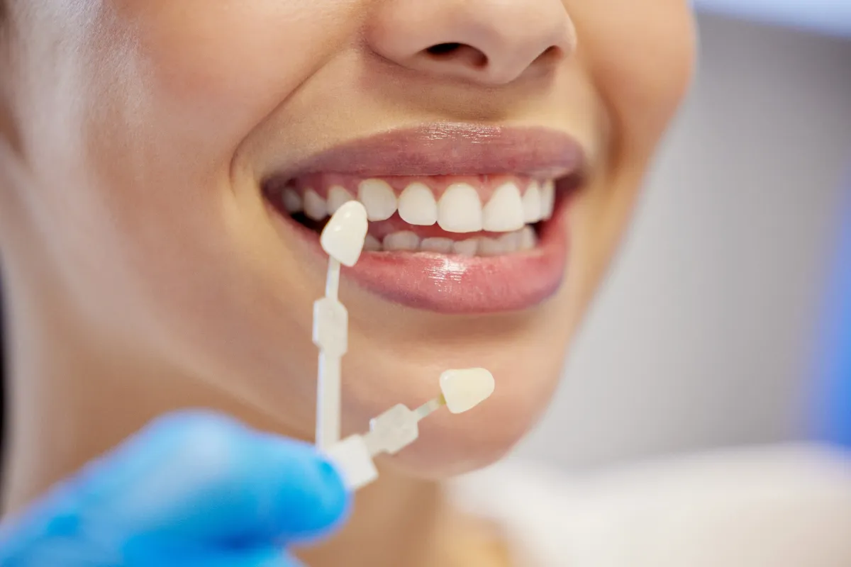 Dental Veneers in Albania