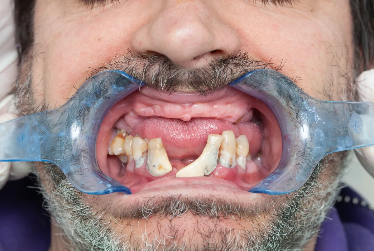 Full Mouth Reconstruction in Albania