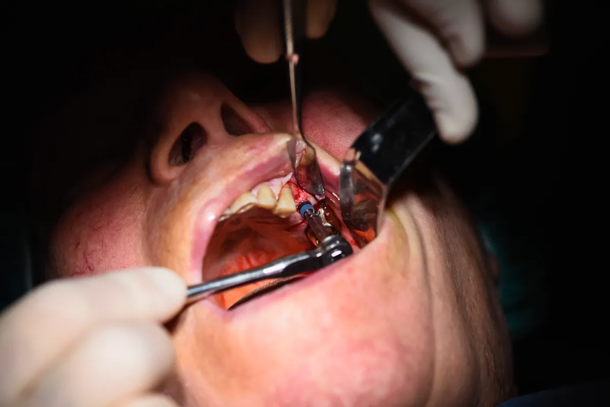 Immediate Loading Dental Implants in Albania