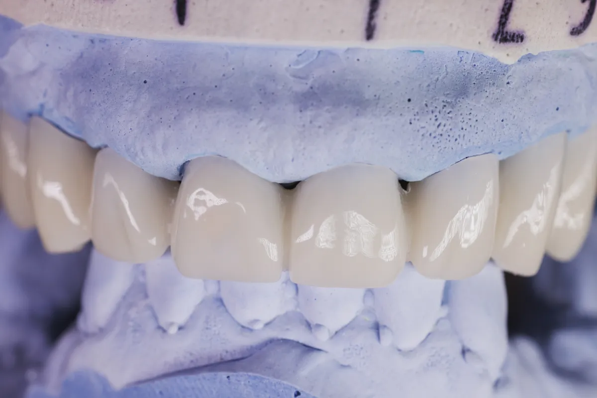 Multiple Implants with Bridges in Albania