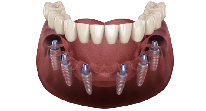 All on 6 Dental Implants in Albania