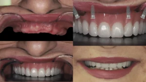complete tooth implant