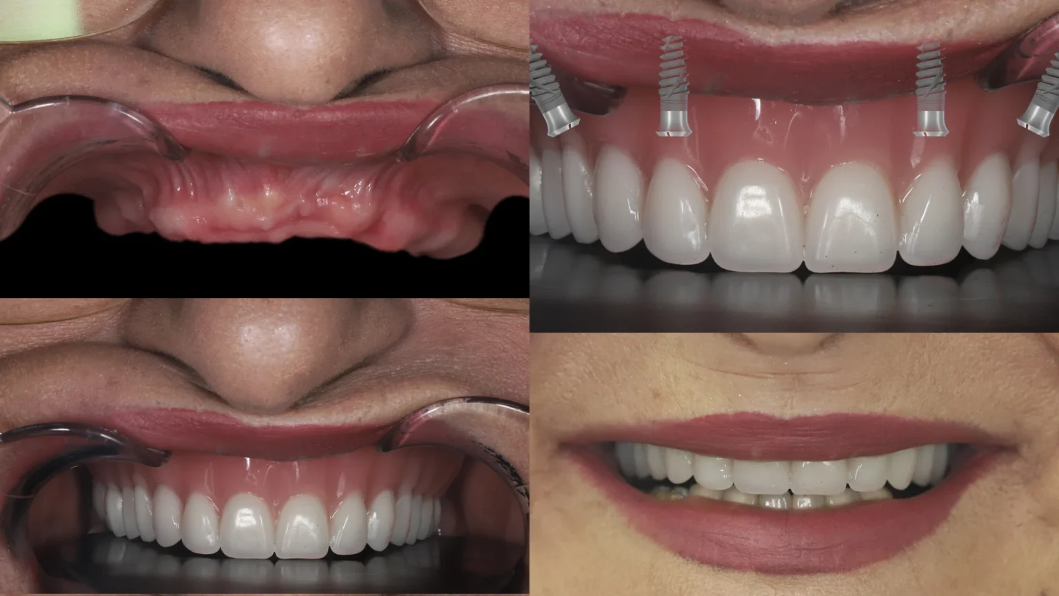 complete dental implants