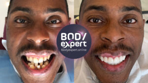 Where is the best place to get dental implants abroad?
