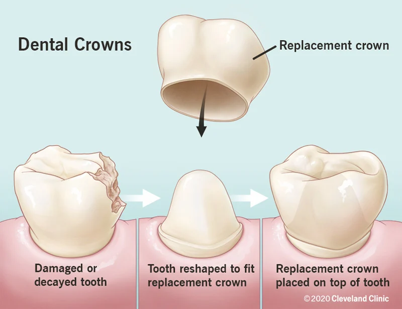 Is a crown a fake tooth?