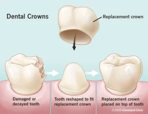 What exactly is a crown on a tooth?