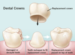 How serious is getting a crown?