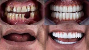 How long do full mouth dental implants last?
