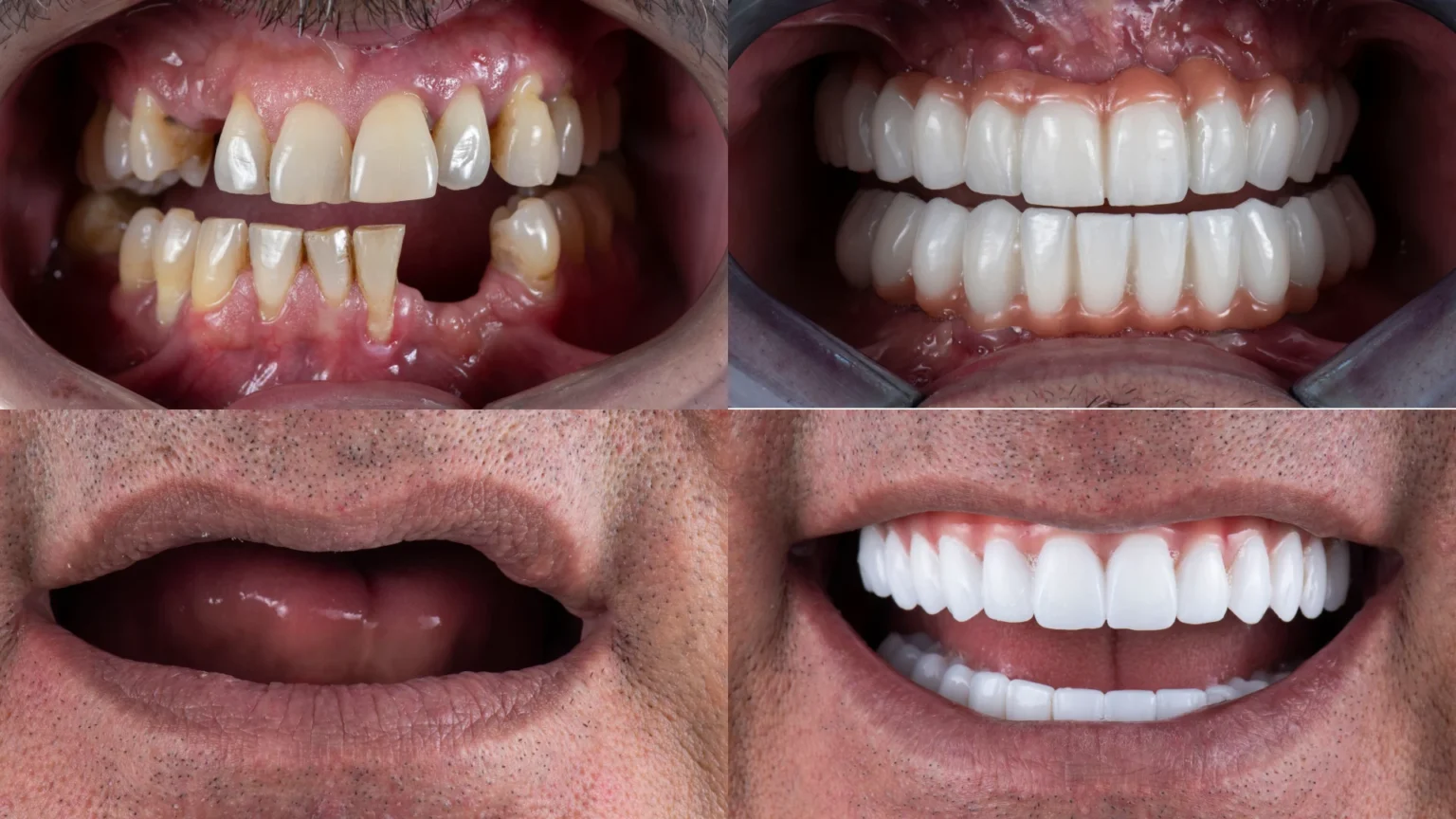 whole mouth dental implants