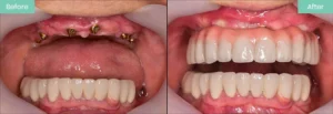all on 4 dental implants uk