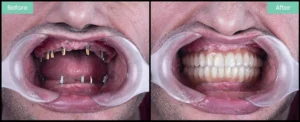 dental implants uk