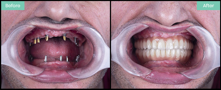 implants uk