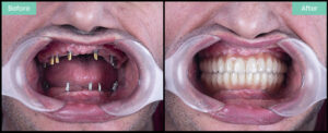 teeth replacement uk