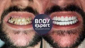 Is it worth getting full dental implants?