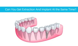 Can you get teeth pulled and implants the same day?