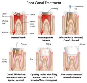 Can you get a crown without a root canal?