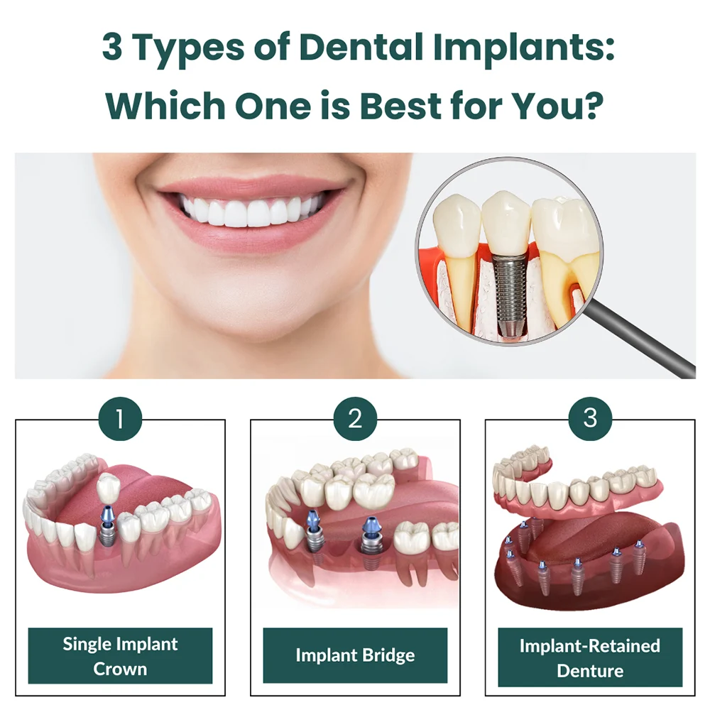What are the three types of dental implants?