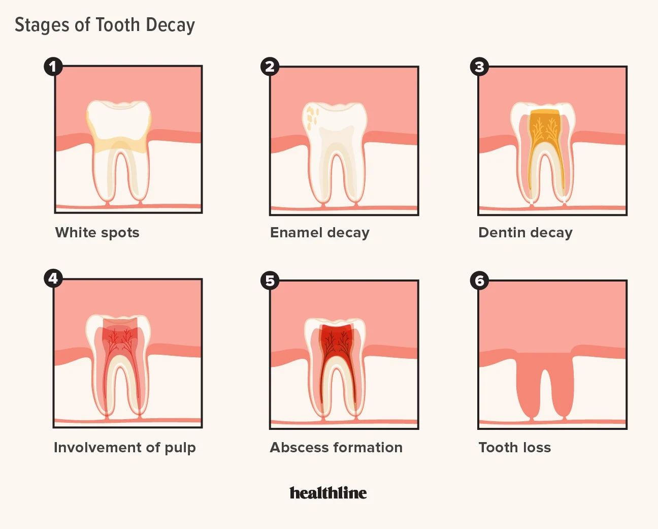 How do I tell if my tooth is decaying?