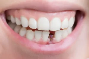 dental implants uk cheap