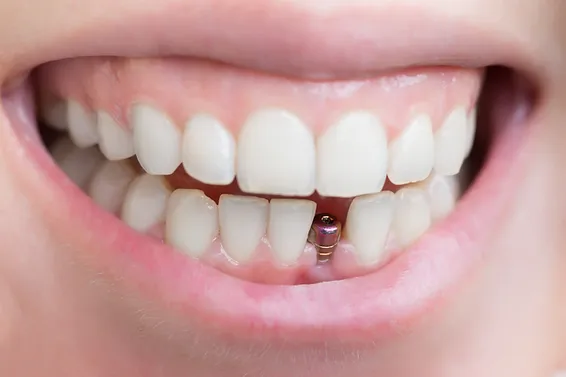 cheapest dental implants in uk