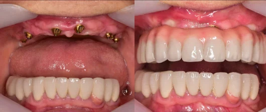 Do gums have to be cut for implants?