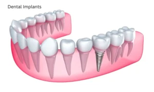 Is there a downside to dental implants?