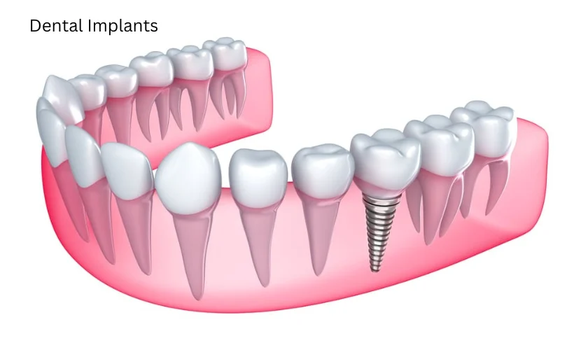 Is there a downside to dental implants?