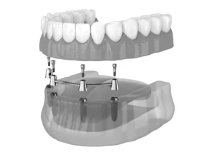 full mouth dental implants uk