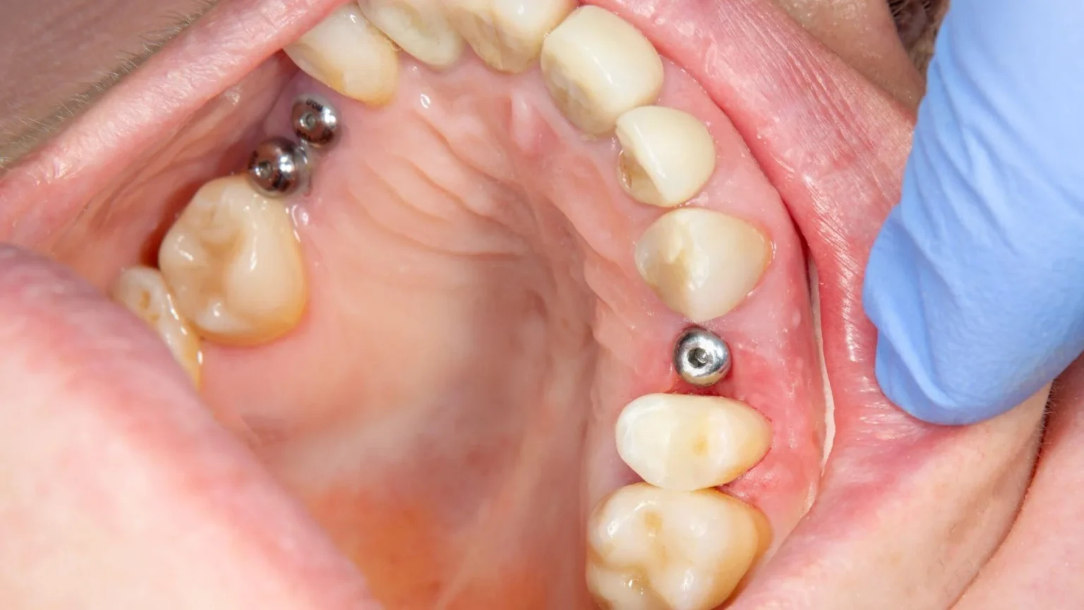 Do they put you to sleep for All-on-4 implants?