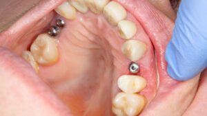 Do they put you to sleep for dental implants?