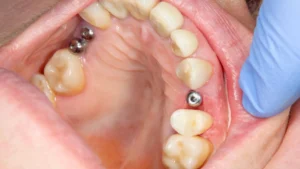 Are you put to sleep for dental implants?