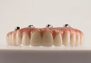 Can full mouth dental implants be done in one day?