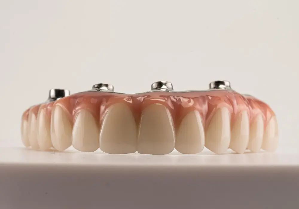Can full mouth dental implants be done in one day?