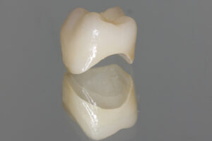 Are NHS crowns as good as private?