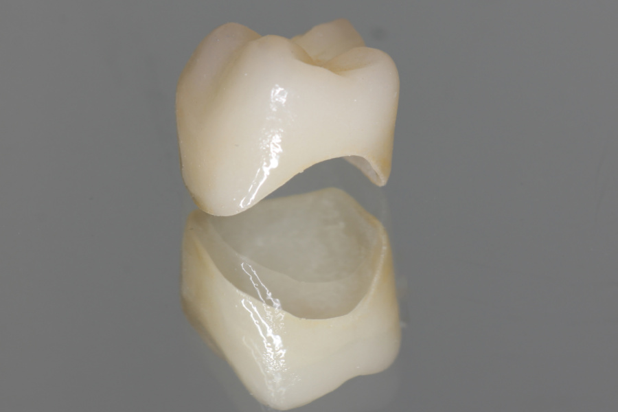 Are NHS crowns as good as private?
