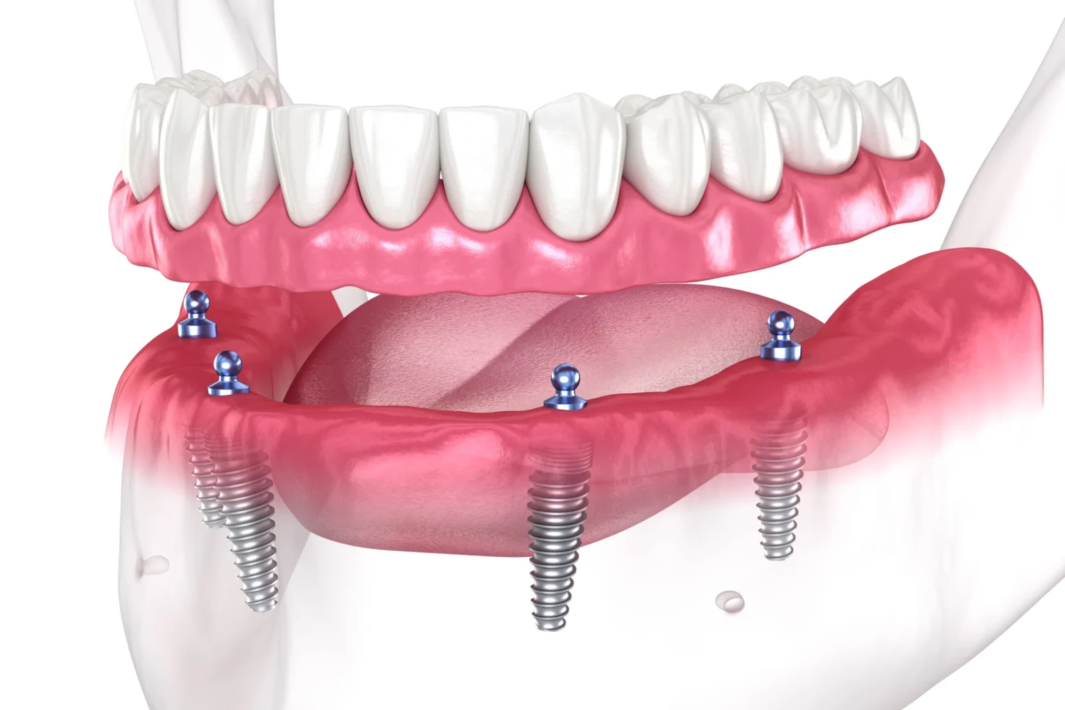 How long does full mouth implant surgery take?