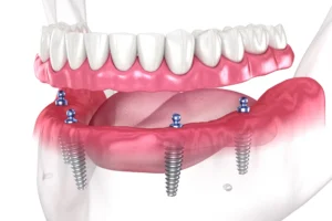 How long does it take to put in a full mouth of implants?