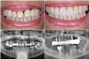 Can All-on-4 implants be done in one day?