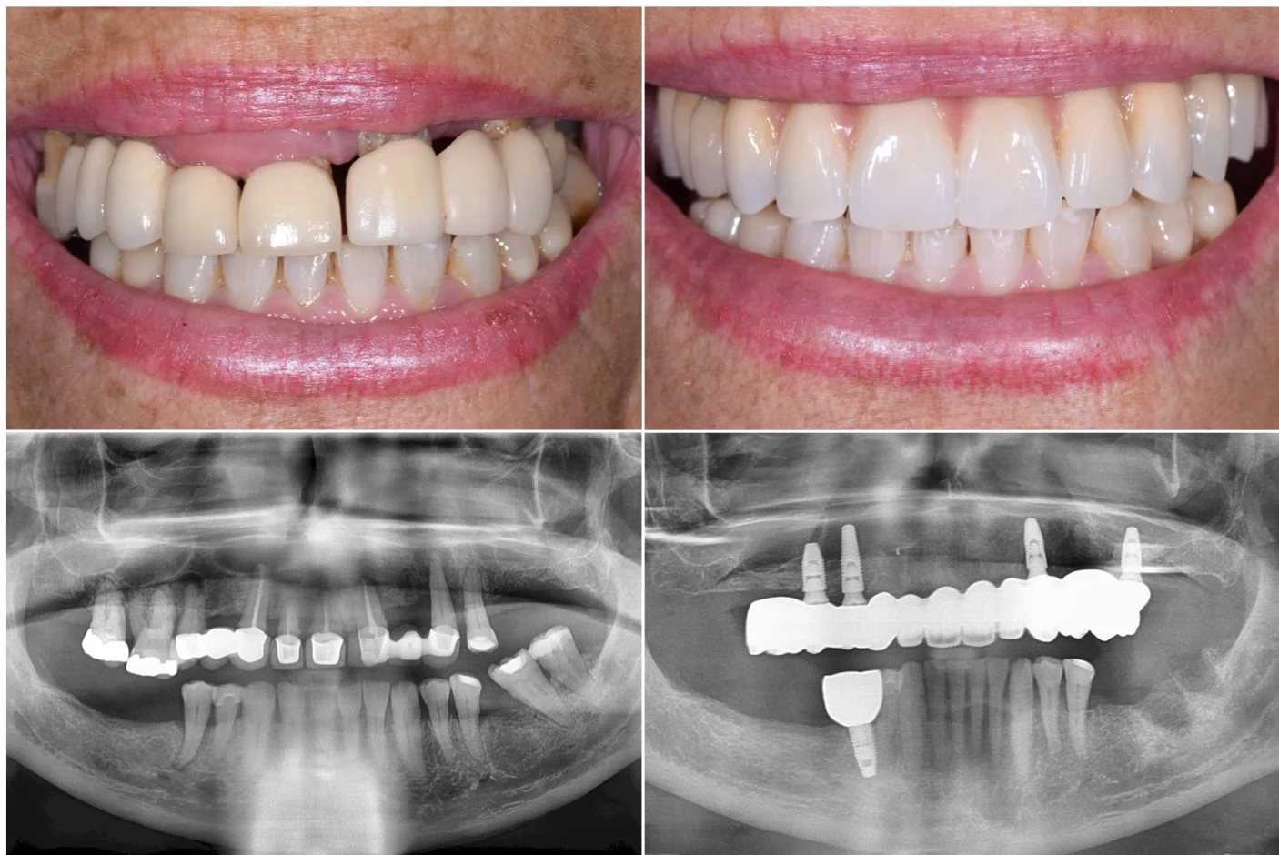 Can All-on-4 implants be done in one day?