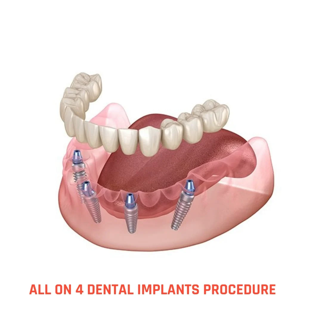 How much is All-on-4 dental implants in Turkey?