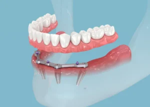 all on four implants