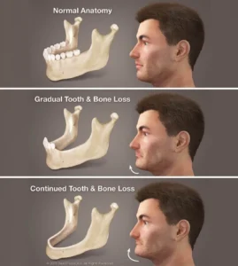 What can you do if you don t have enough bone for dental implants?