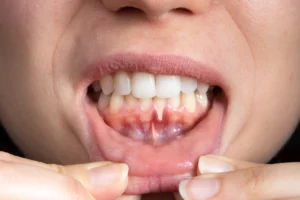When is it too late to fix receding gums?