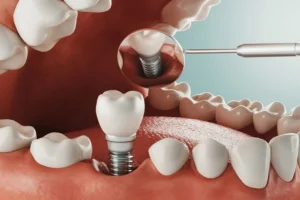 Can implants be done in one day?