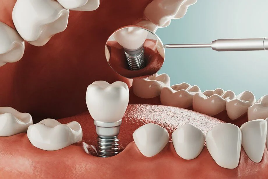 Can implants be done in one day?