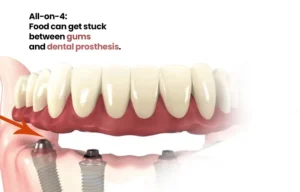 Can food get under All-on-4 implants?