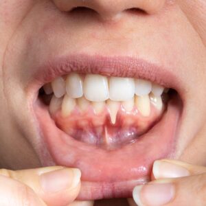 Can I get implants with receding gums?